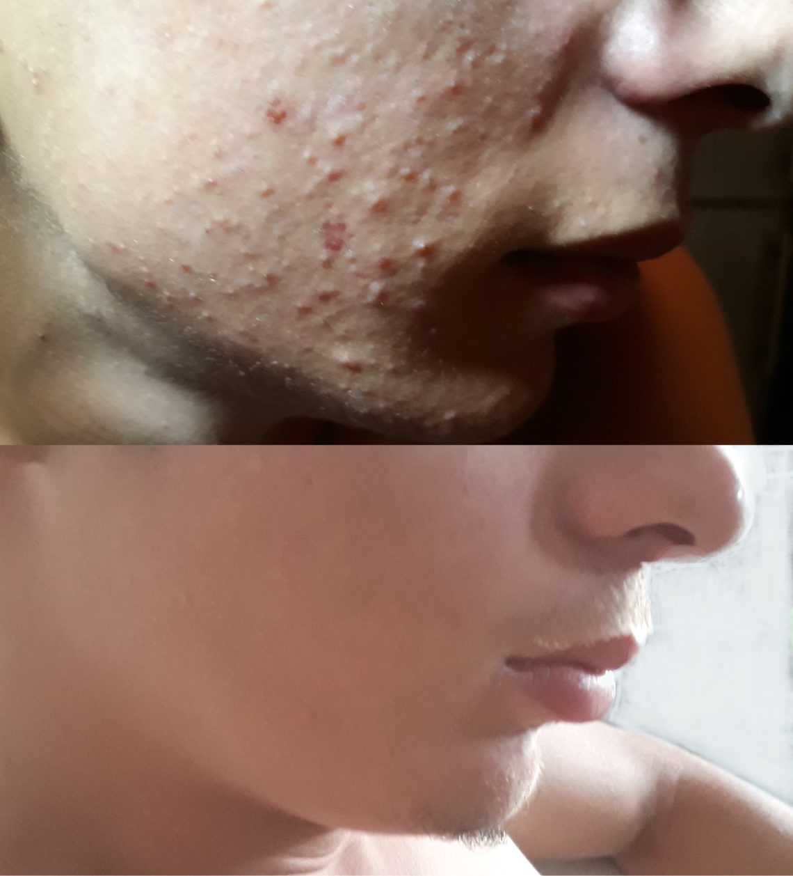 Acne giovanile