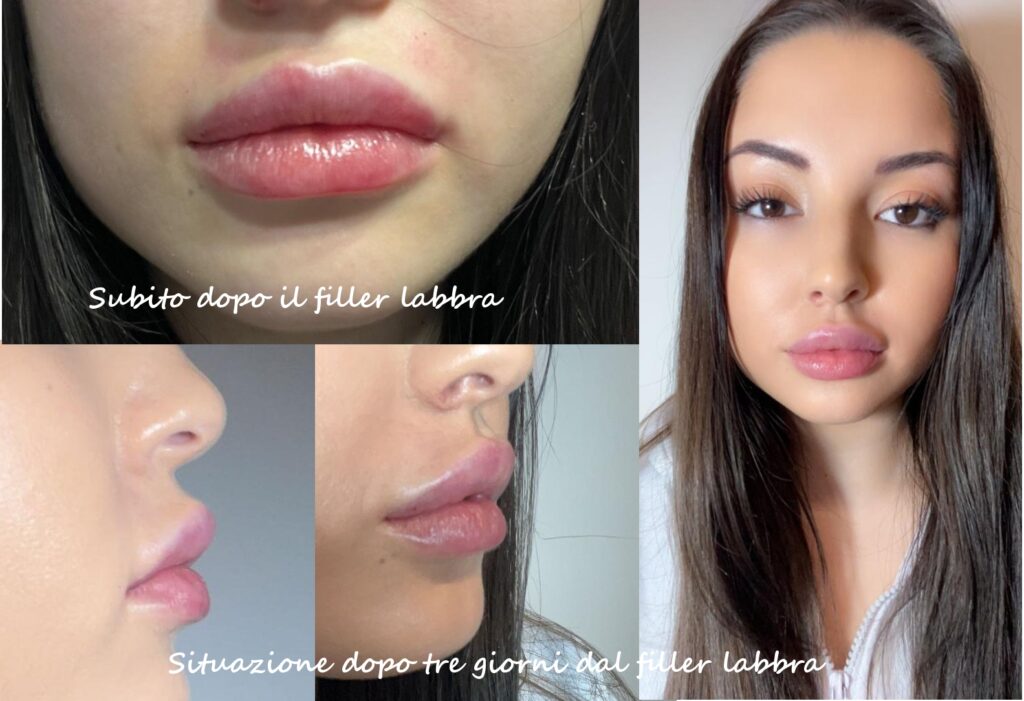 filler labbra tecnica ibrida