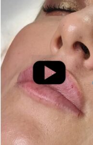 Filler labbra