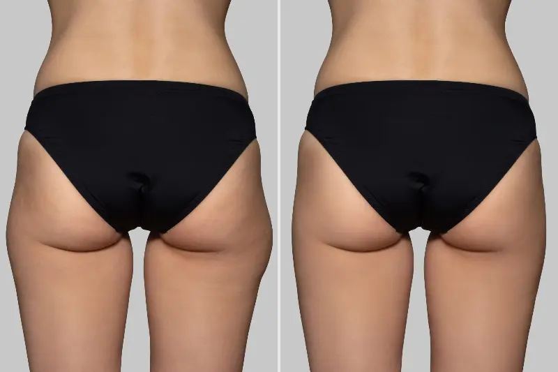 Glutei rimodellati senza chirurgia