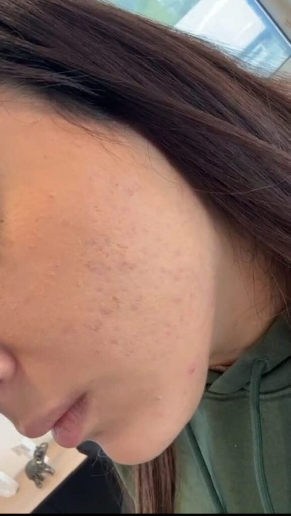 dopo - acne vulgaris scomparsa