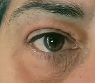 Blefaro non chirurgica dopo